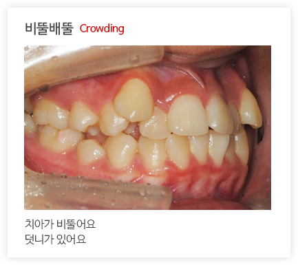 비뚤배뚤 Crowding