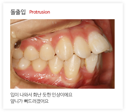 돌출입 Protrusion