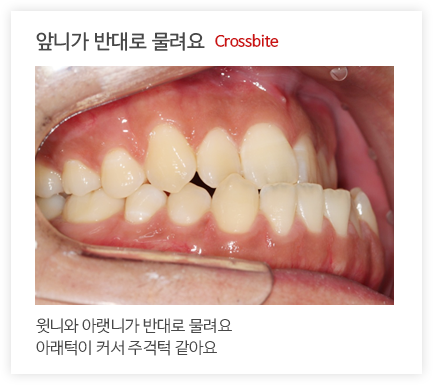 앞니가 반대로 물려요 Crossbite