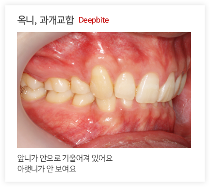 옥니, 과개교합 Deepbite