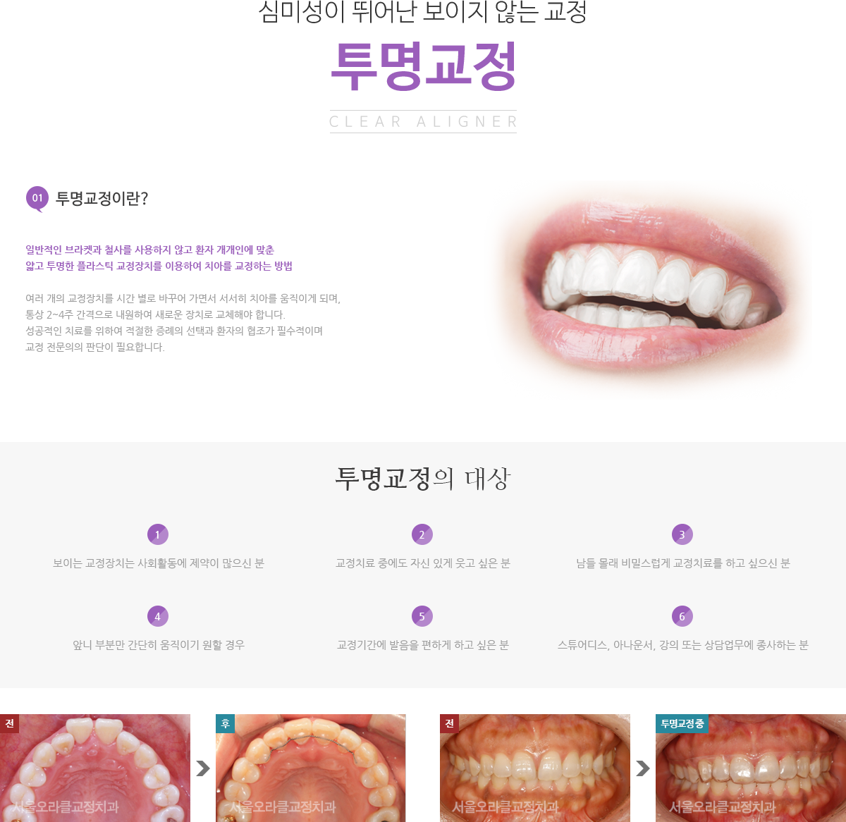 투명교정