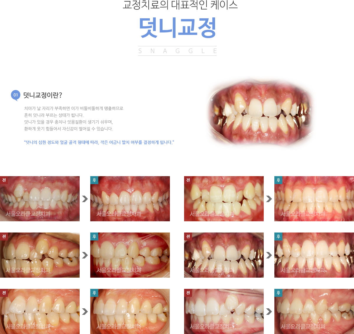 덧니교정