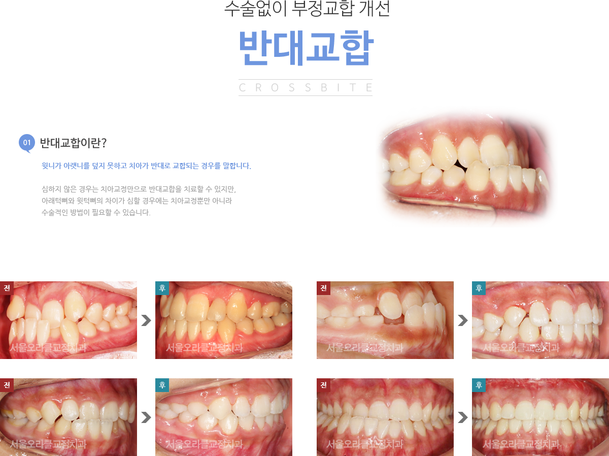 반대교합