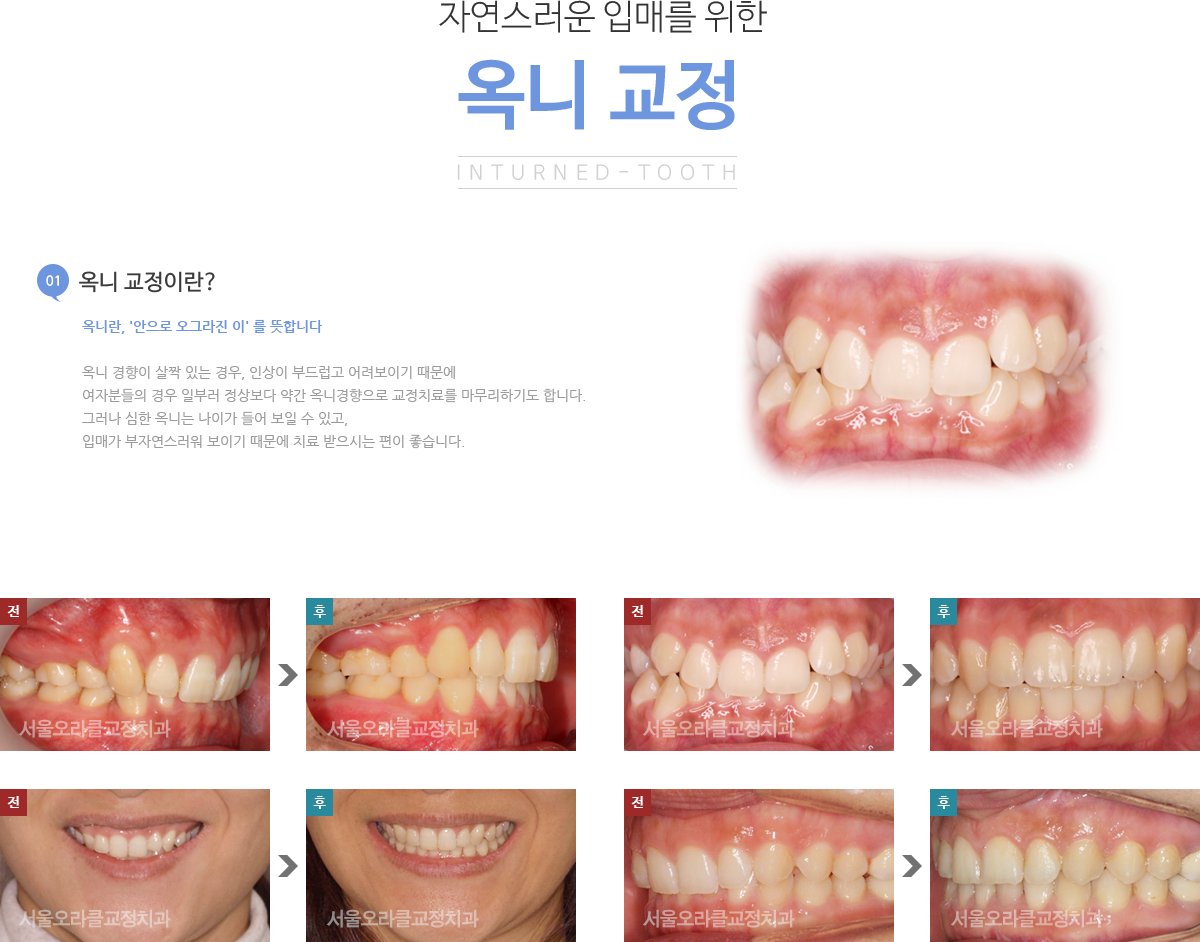 옥니 교정