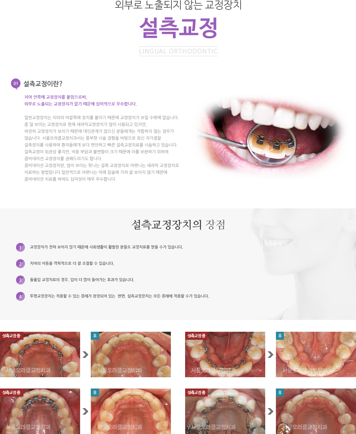 설측교정