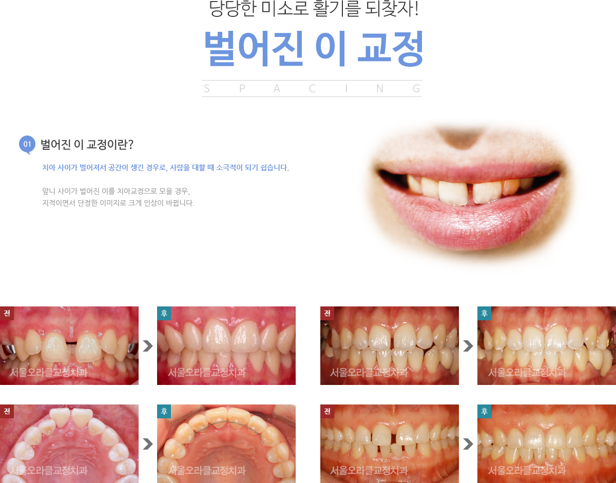 벌어진 이 교정