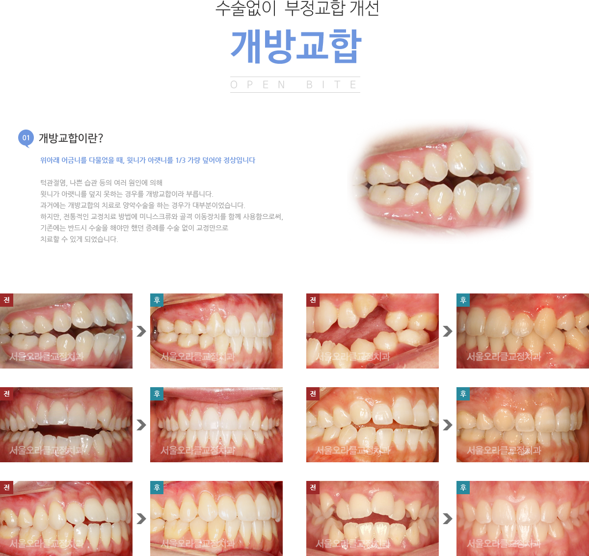 개방교합